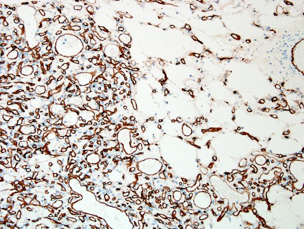 15D3 Hemangioblastoma (Case 15) CD34 5.jpg