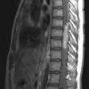 16A Hemangioblastoma (Case 16) T1 Contrast - Copy