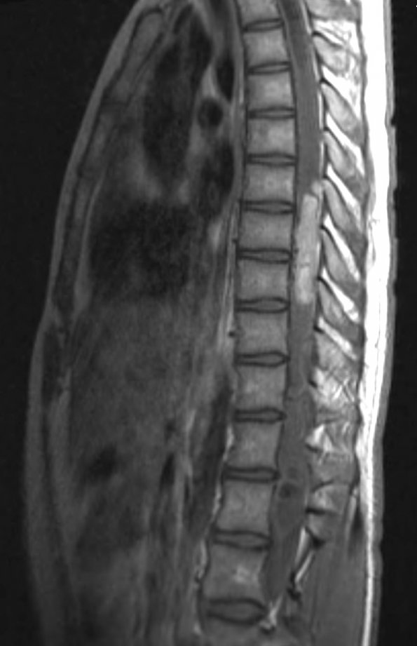 16A Hemangioblastoma (Case 16) T1 Contrast - Copy