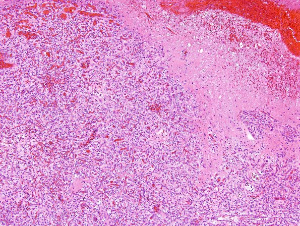 16B1 Hemangioblastoma (Case 16) H&E 11