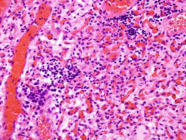 16B2 Hemangioblastoma (Case 16) H&E 6