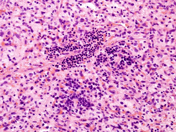 16B3 Hemangioblastoma (Case 16) H&E 8