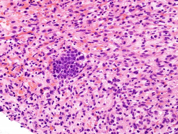 16B4  Hemangioblastoma (Case 16) H&E 4