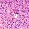 16B5 Hemangioblastoma (Case 16) H&E 5