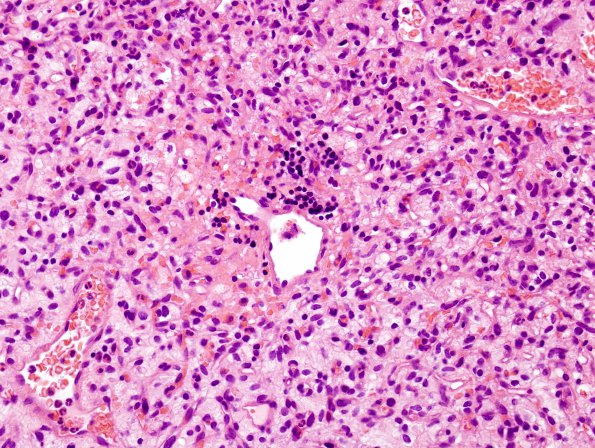 16B5 Hemangioblastoma (Case 16) H&E 5