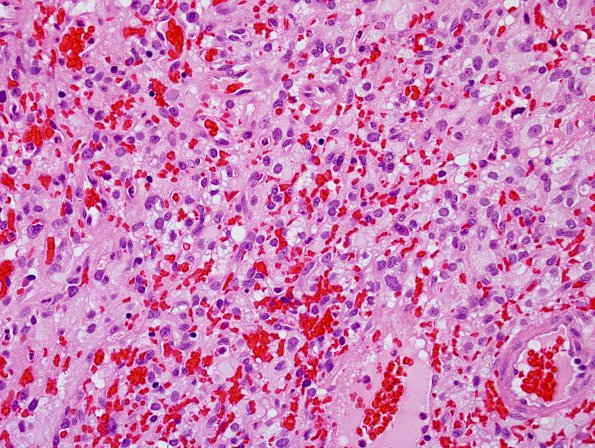 17A1 Hemangioblastoma (Case 17) H&E 5.jpg