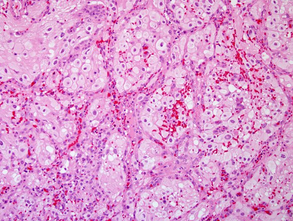 17A2 Hemangioblastoma (Case 17) H&E 6.jpg