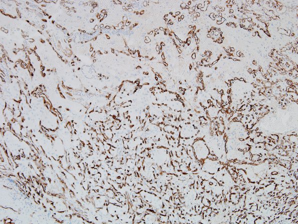 17B Hemangioblastoma (Case 17) CD34 1.jpg