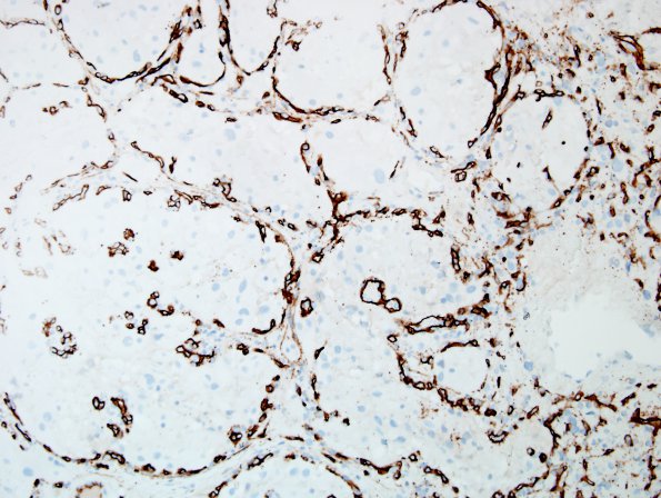 17B Hemangioblastoma (Case 17) CD34 2.jpg