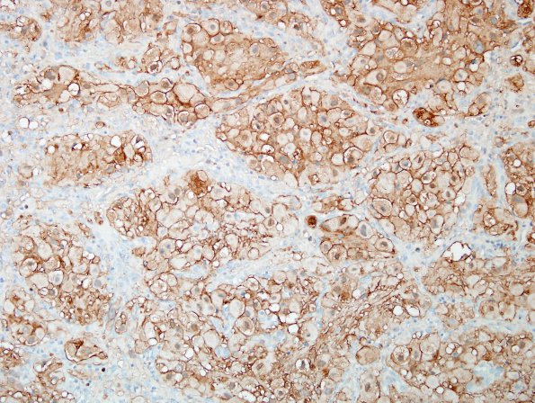 17C1 Hemangioblastoma (Case 17) S100 4.jpg