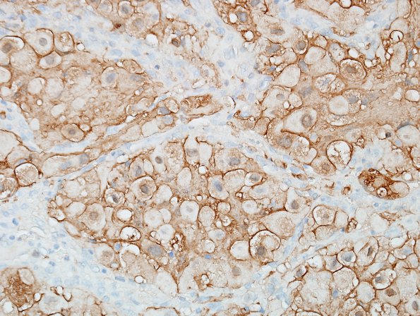 17C2 Hemangioblastoma (Case 17) S100 3.jpg