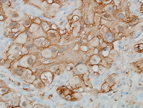 17C3 Hemangioblastoma (Case 17) S100 1.jpg