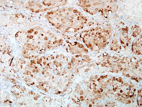 17D1 Hemangioblastoma (Case 17) Inhibin 4.jpg