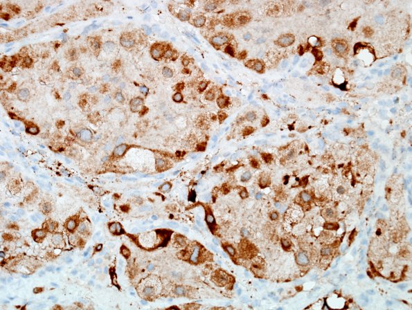 17D2 Hemangioblastoma (Case 17) Inhibin 1.jpg