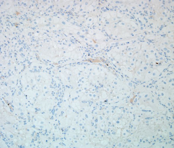 17E Hemangioblastoma (Case 17) PAX-8 2.jpg