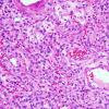 18A Hemangioblastoma (Case 18) 1.jpg