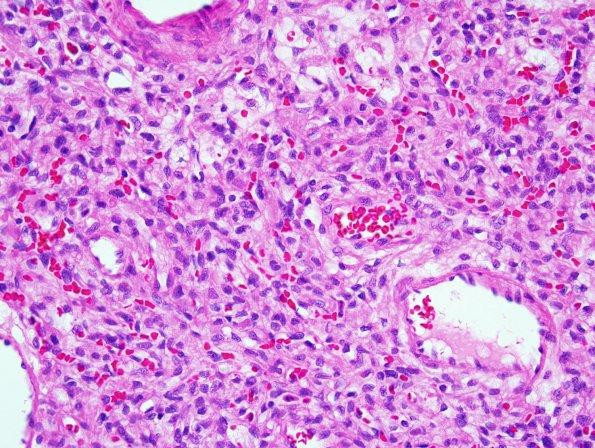 18A Hemangioblastoma (Case 18) 1.jpg