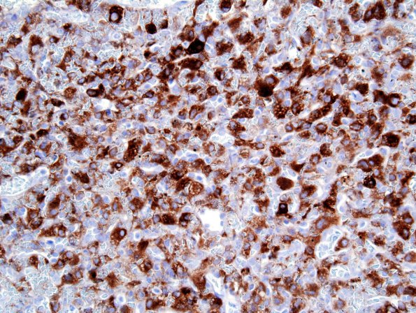 18B1 Hemangioblastoma (Case 18) Inhibin 2.jpg