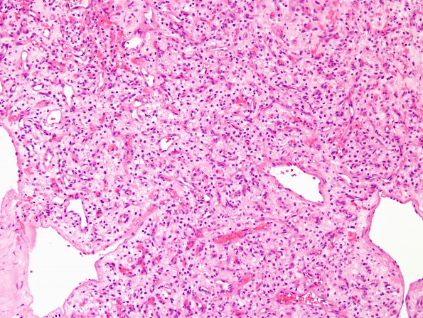 19A1 Hemangioblastoma (Case 19) H&E 4