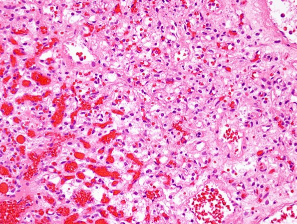 19A2 Hemangioblastoma (Case 19) H&E 2