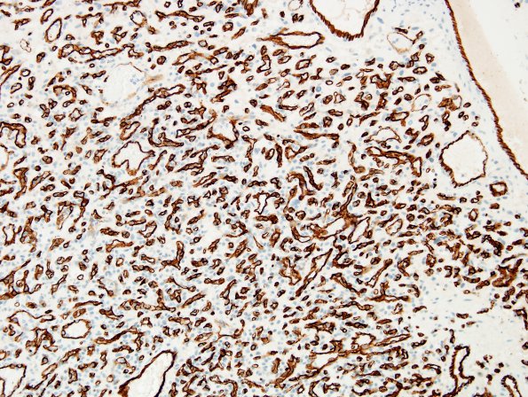 19B Hemangioblastoma (Case 19) CD34 3