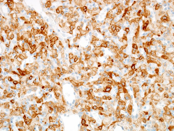 19C Hemangioblastoma (Case 19) Inhibin 3