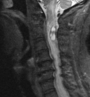 1A1 (Case 1) STIR Crop - Copy