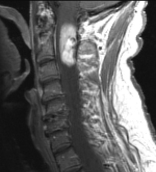 1A3 (Case 1) T1W Crop - Copy