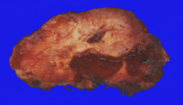 1B Hemangioblastoma (Case 1) Gross 3