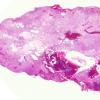 1C1 Hemangioblastoma (Case 1) H&E WM