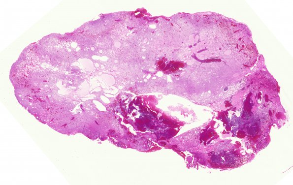 1C1 Hemangioblastoma (Case 1) H&E WM