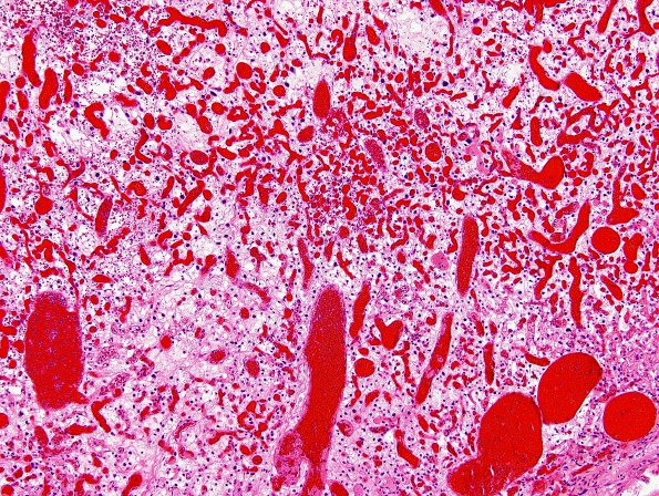 1C2 Hemangioblastoma (Case 1) H&E 1