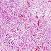 1C3 Hemangioblastoma (Case 1) H&E 4