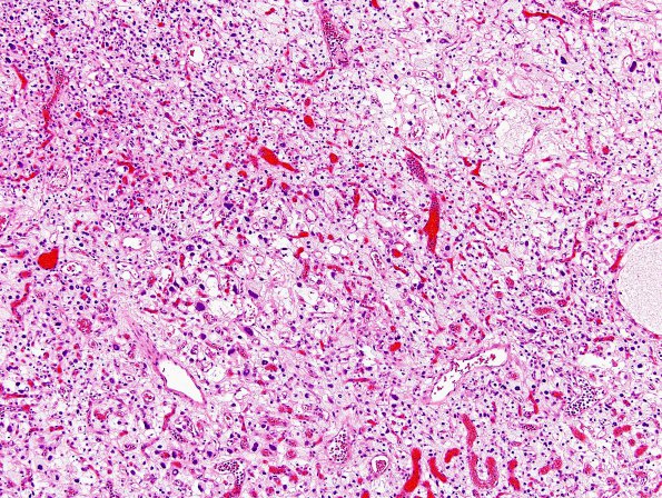 1C3 Hemangioblastoma (Case 1) H&E 4
