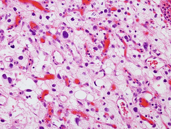 1C4 Hemangioblastoma (Case 1) H&E 3