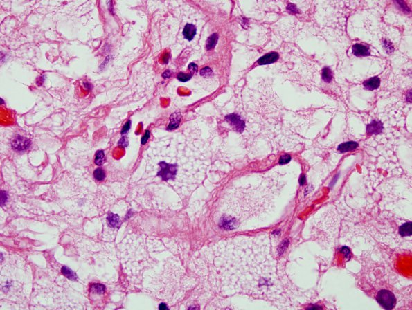 1C5 Hemangioblastoma (Case 1) H&E 8