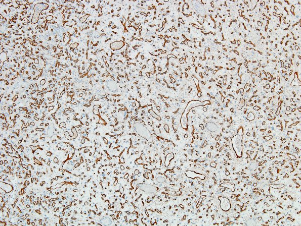 1D1 Hemangioblastoma (Case 1) CD34 4