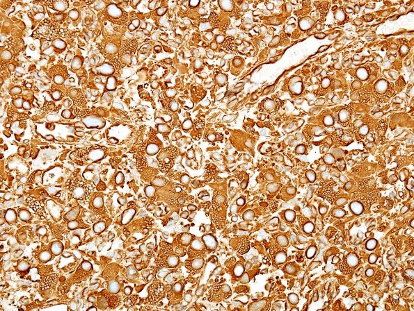 1F Hemangioblastoma (Case 1) VIM 2