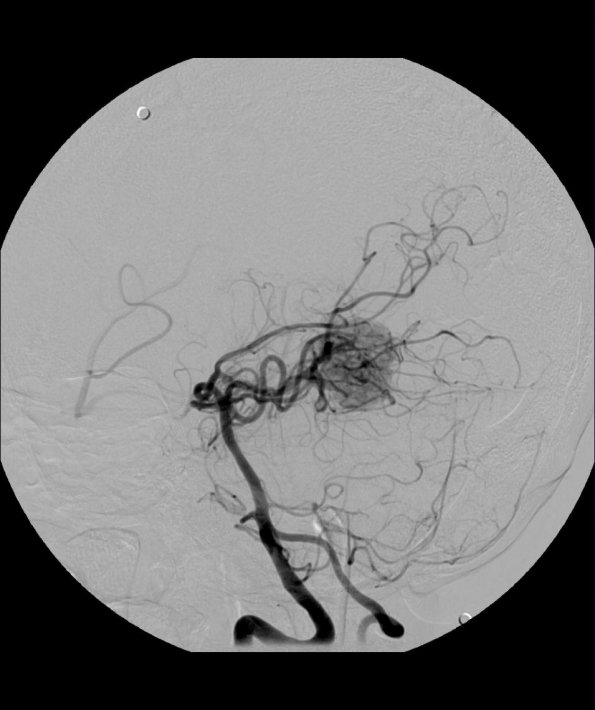 20A1 Hemangioblastoma (Case 20) Angiogram R Vert obl 2 - Copy