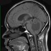20A2 Hemangioblastoma (Case 20) MRI 1 - Copy