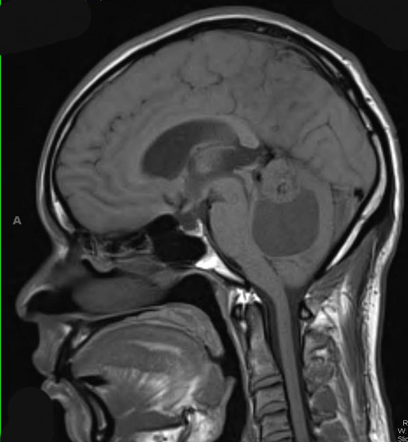 20A2 Hemangioblastoma (Case 20) MRI 1 - Copy