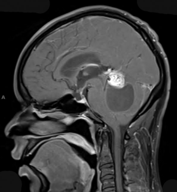 20A3 Hemangioblastoma (Case 20) T1 W 2 - Copy