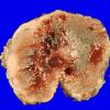 20B Hemangioblastoma (Case 20) gross_2