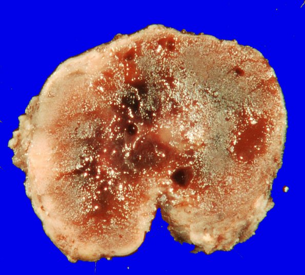 20B Hemangioblastoma (Case 20) gross_2