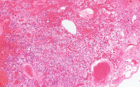 20C Hemangioblastoma (Case 20) H&E 10X