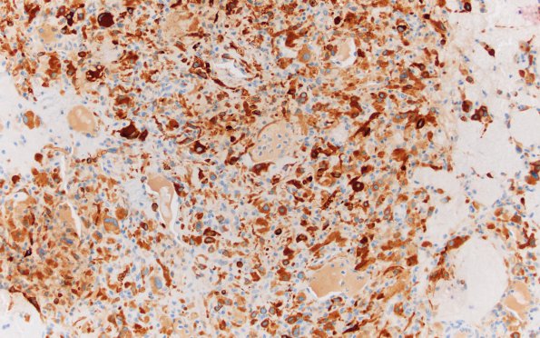 20D1 Hemangioblastoma (Case 20) Inhibin 20X