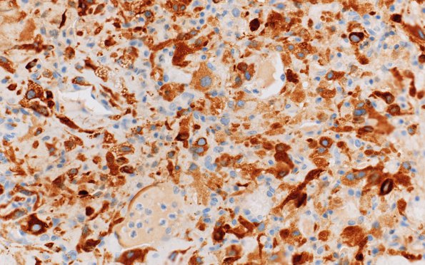 20D2 Hemangioblastoma (Case 20) Inhibin 40X