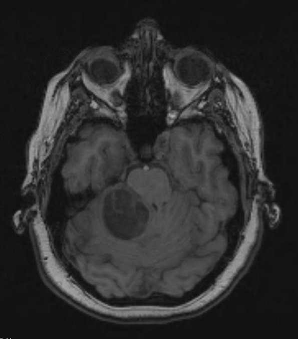 21A1 Hemangioblastoma (Case 21) T1 1 - Copy