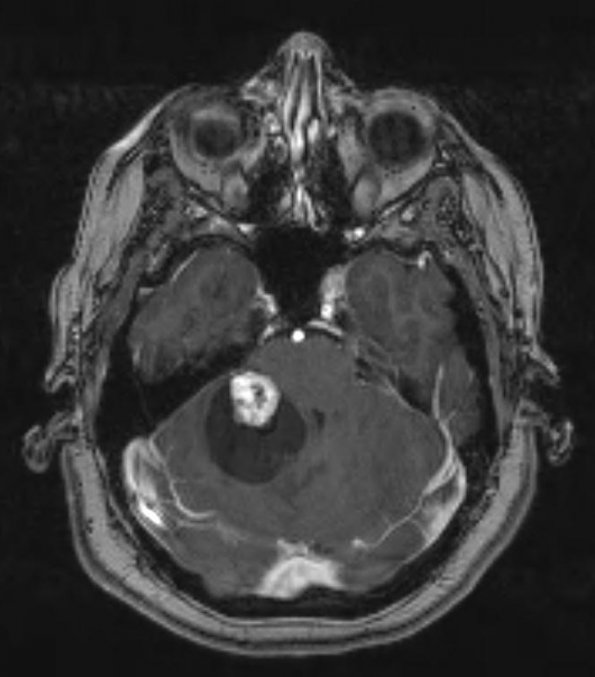 21A2 Hemangioblastoma (Case 21) T1 W 1 - Copy