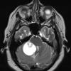 21A3 Hemangioblastoma (Case 21) T2 W 1 - Copy